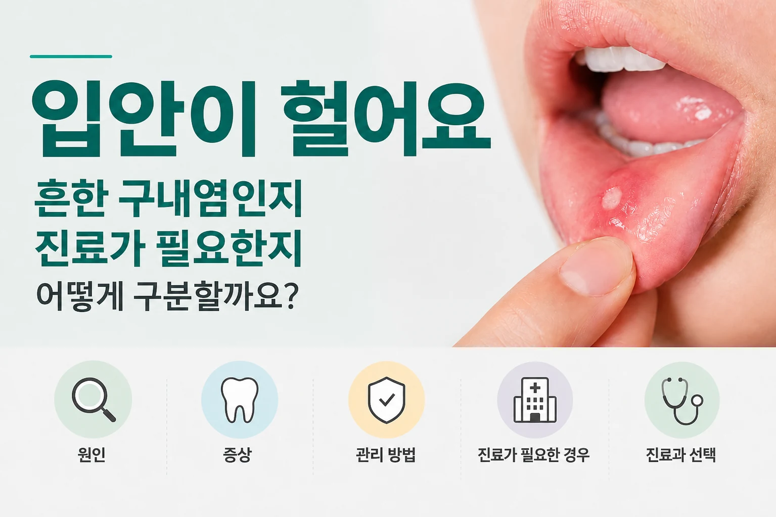 입안이 헐었을 때 흔한 구내염인지 진료가 필요한지 구분하는 대표이미지