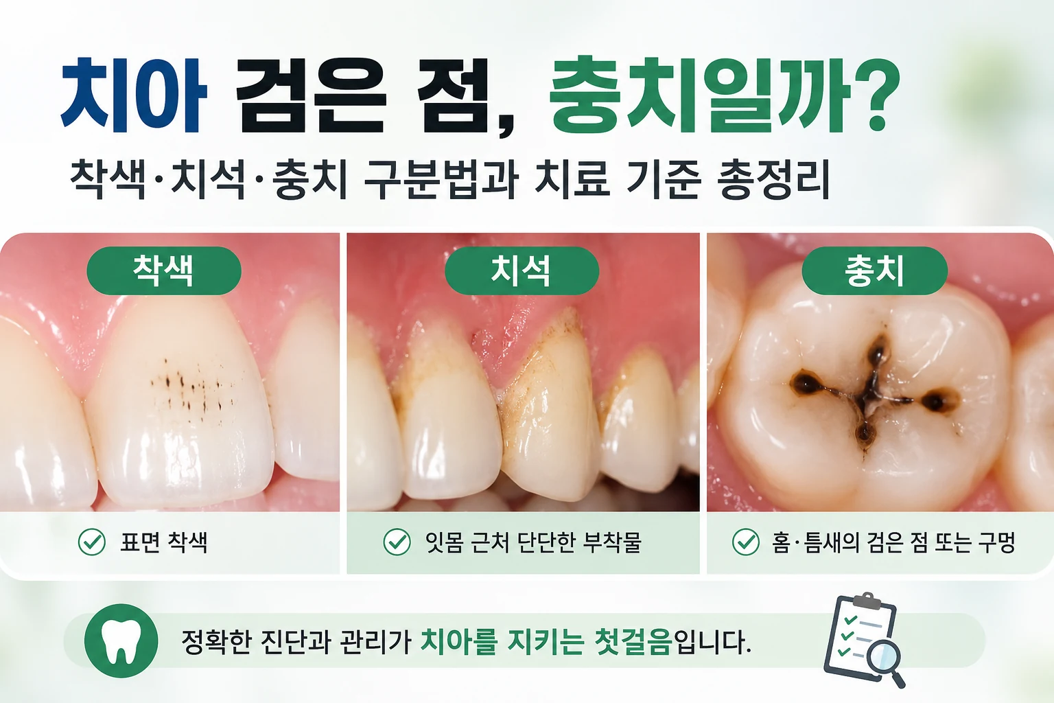 치아의 검은 점을 보여주는 어금니 사진과 착색인지 충치인지 확인하는 대표이미지