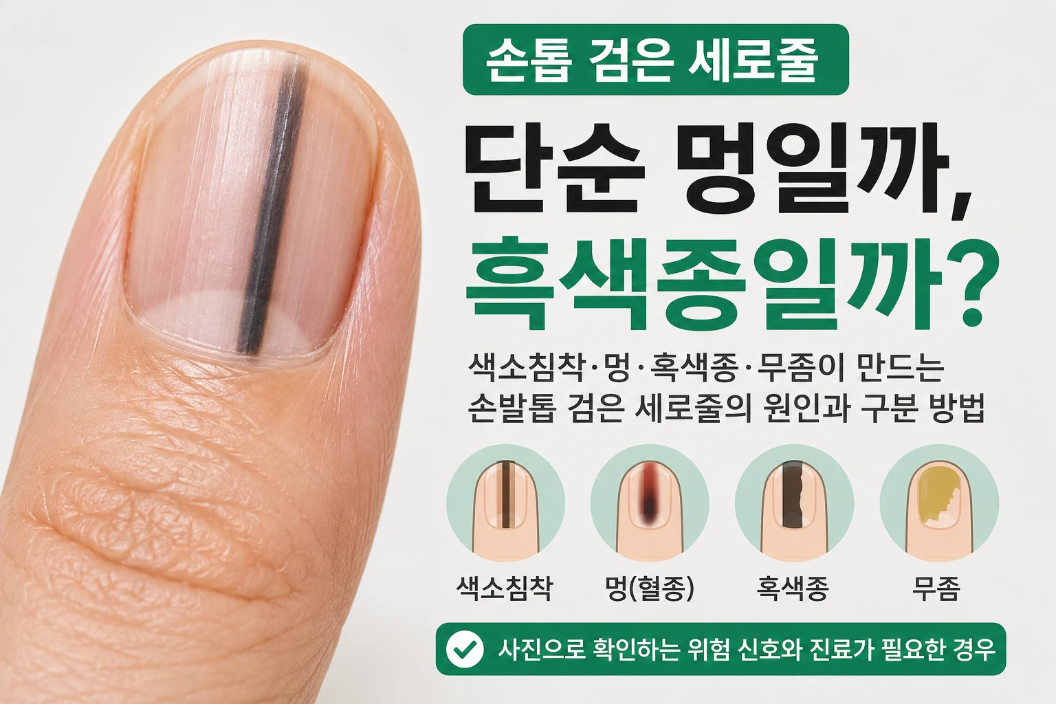 손톱에 생긴 검은 세로줄의 폭과 색 변화를 확인하는 방법을 안내하는 대표이미지
