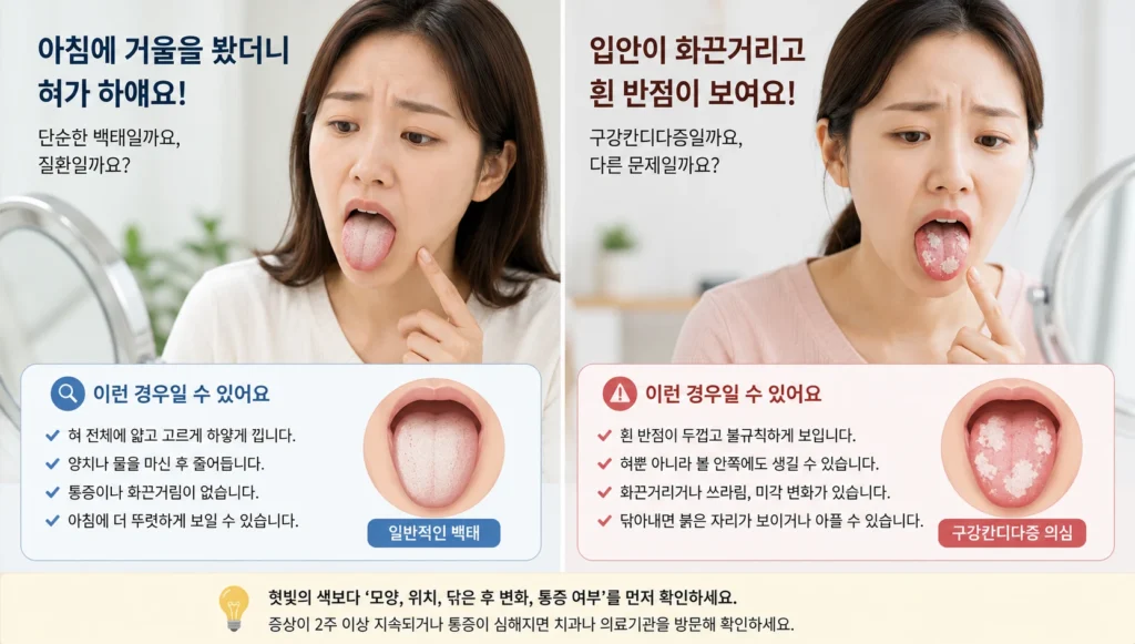 거울을 보며 혀가 하얗게 보이는 일반적인 백태와 입안이 화끈거리고 두꺼운 흰 반점이 나타난 구강칸디다증 의심 상황을 두 장면으로 비교한 이미지