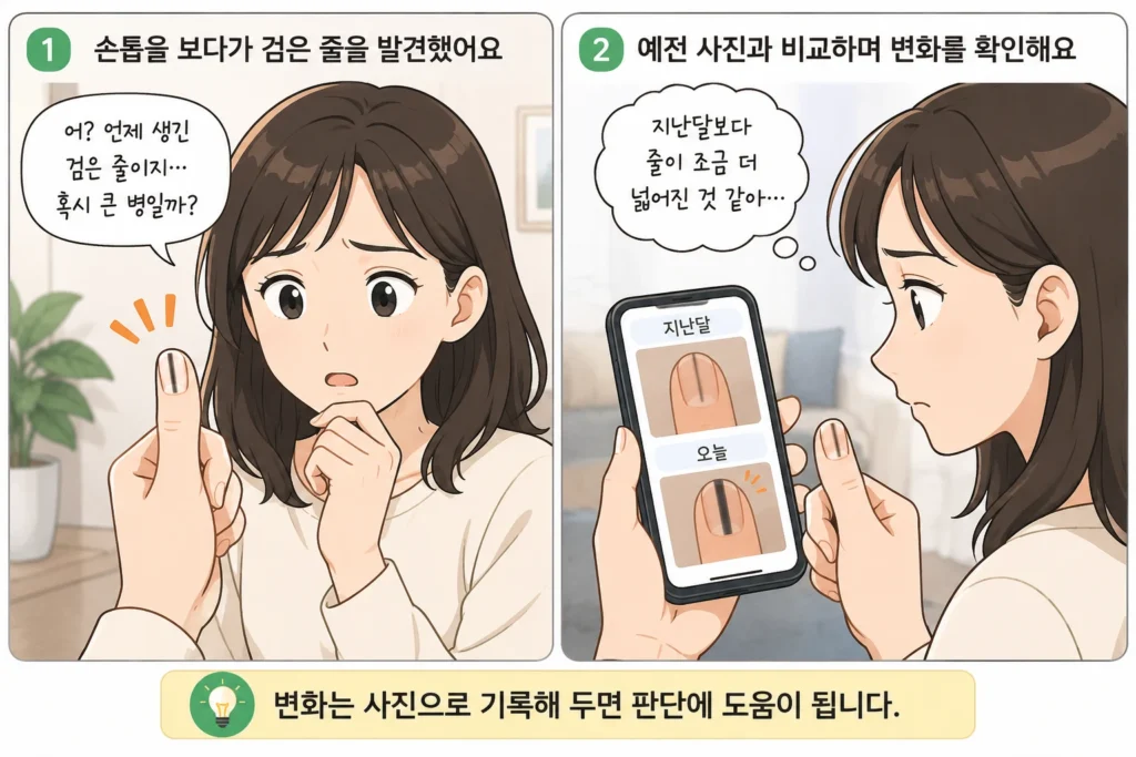 손톱에 검은 세로줄을 처음 발견해 걱정하는 모습과 이전 사진을 비교하며 줄의 변화를 확인하는 모습을 담은 공감형 2컷 이미지