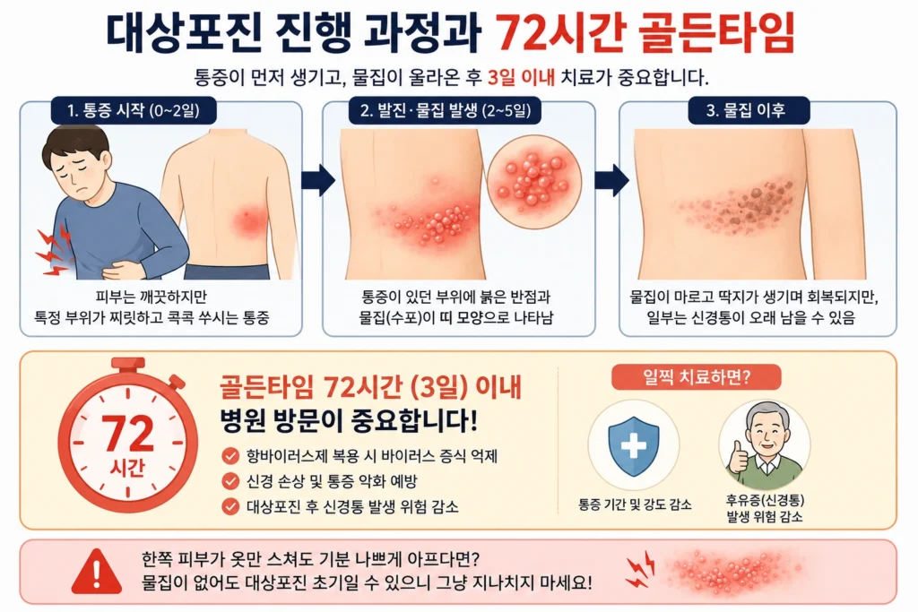 대상포진에서 피부 통증이 먼저 시작된 뒤 붉은 반점과 물집이 나타나는 과정과 물집 발생 후 72시간 이내 진료가 중요함을 안내한 이미지
