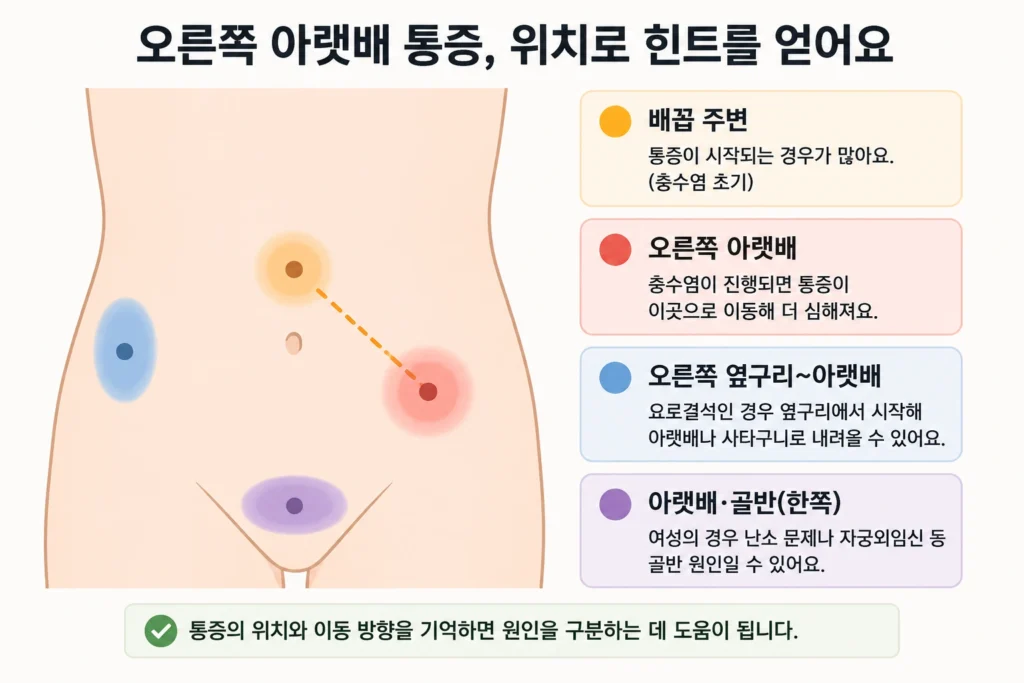 배꼽 주변에서 오른쪽 아랫배로 이동하는 충수염 통증, 옆구리에서 아랫배로 내려오는 요로결석 통증, 한쪽 골반 통증 위치를 단순한 복부 지도에 표시한 이미지