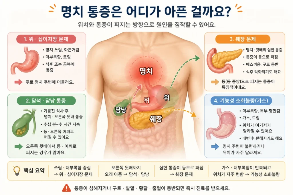 명치 주변의 위와 십이지장, 오른쪽 윗배의 담낭, 등으로 퍼질 수 있는 췌장 통증 위치를 상복부 지도에 표시한 이미지