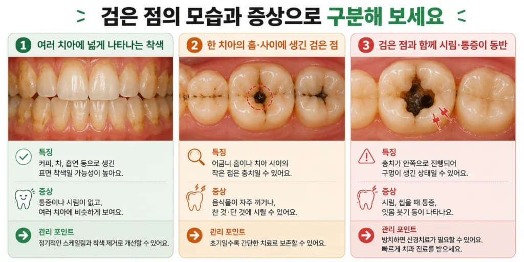 여러 치아에 넓게 나타난 표면 착색, 한 치아의 홈이나 사이에 생긴 검은 점, 검은 점과 함께 시림·통증이 동반된 경우를 비교한 이미지