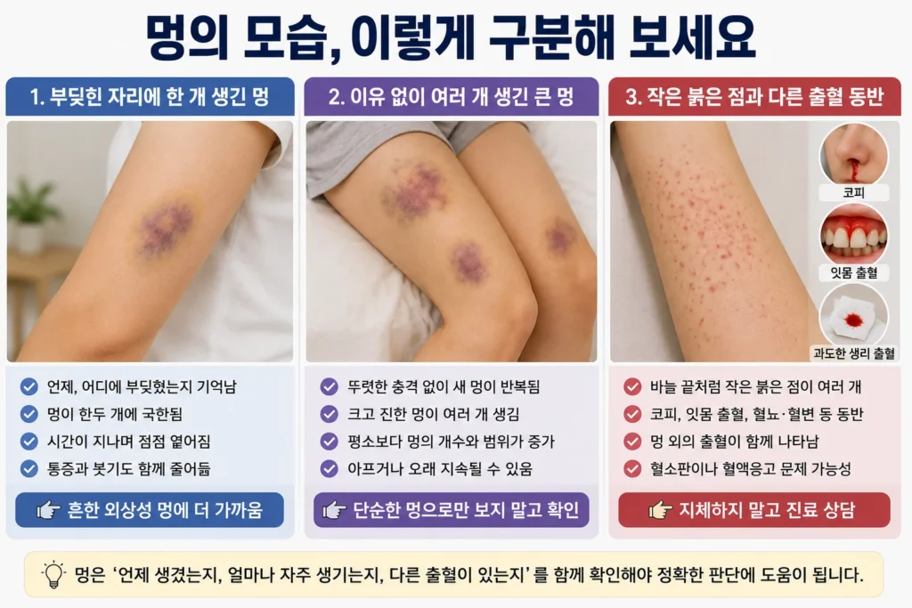 부딪힌 자리에 한 개 생긴 흔한 멍, 이유 없이 여러 개 반복되는 큰 멍, 작은 붉은 점과 코피·잇몸 출혈 등 다른 출혈이 함께 나타난 경우를 비교한 이미지