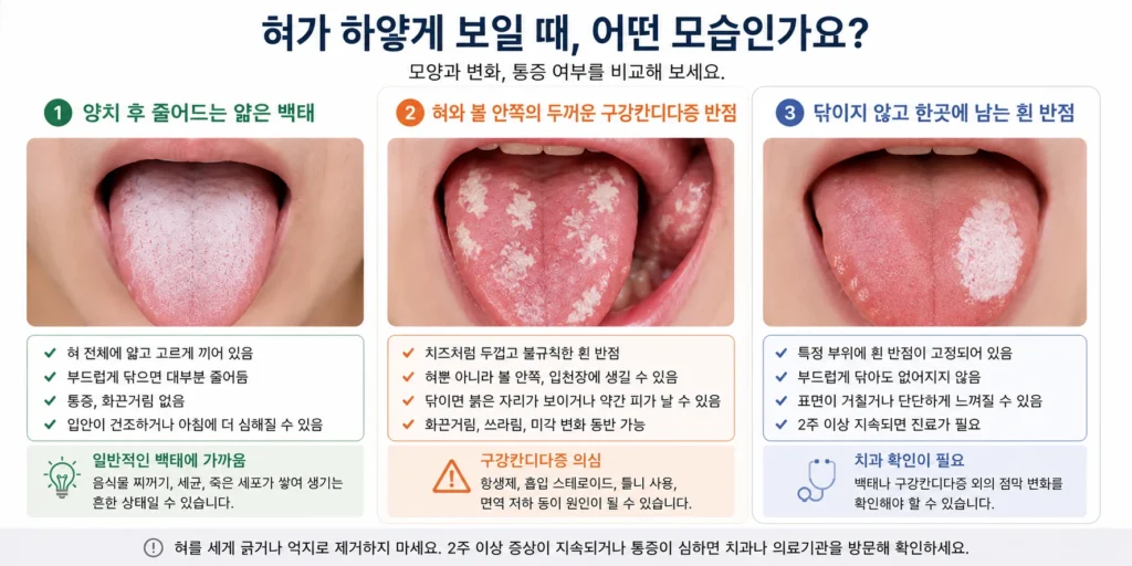 양치 후 줄어드는 얇은 백태, 혀와 볼 안쪽에 두껍고 불규칙하게 생긴 구강칸디다증 반점, 닦이지 않고 한곳에 남는 흰 반점을 세 가지로 비교한 이미지