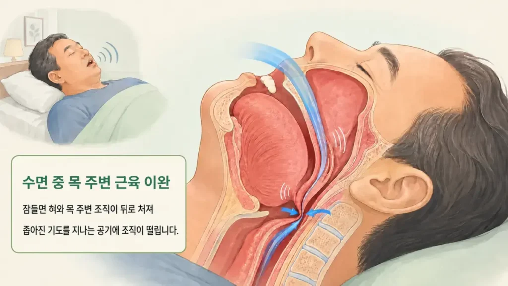 잠들면 혀와 목 주변 조직이 뒤로 처져 좁아진 기도에서 코골이가 생기는 과정을 설명한 그림