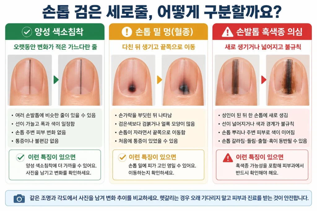 폭과 색이 일정해 오랫동안 변화가 적은 손톱 세로줄과 줄이 넓어지고 경계가 불규칙해 피부과 확인이 필요한 손톱 세로줄을 비교한 이미지