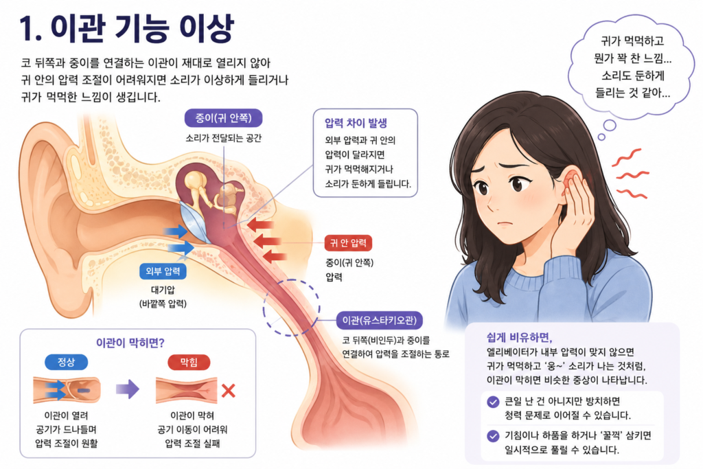 이관 기능 이상으로 귀 안의 압력 균형이 깨져 귀가 먹먹해지는 원리를 설명하는 귀 단면 일러스트