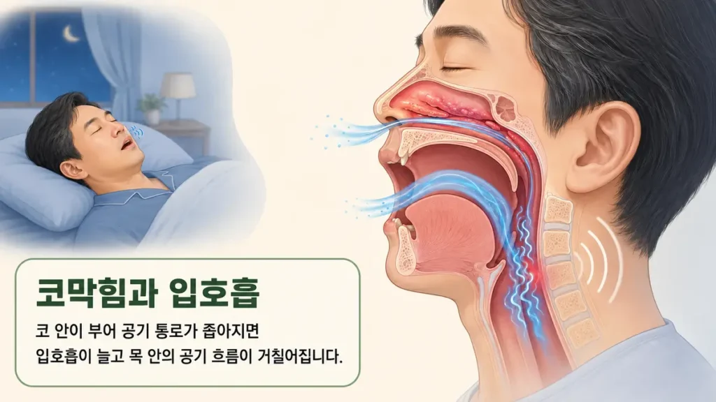 코 안이 부어 공기 통로가 좁아지고 입호흡이 늘면서 코골이가 심해지는 과정을 설명한 그림