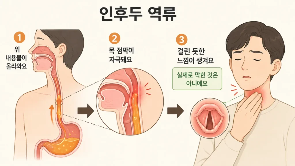 위 내용물이 목으로 역류해 점막을 자극하고 실제로 막히지 않았지만 걸린 듯한 느낌이 생기는 과정