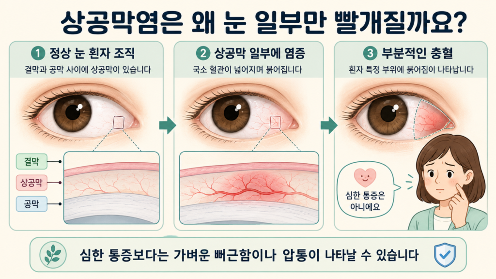 눈 흰자 표면의 상공막 일부에 염증이 생겨 국소적인 충혈과 가벼운 불편감이 나타나는 과정을 설명한 일러스트