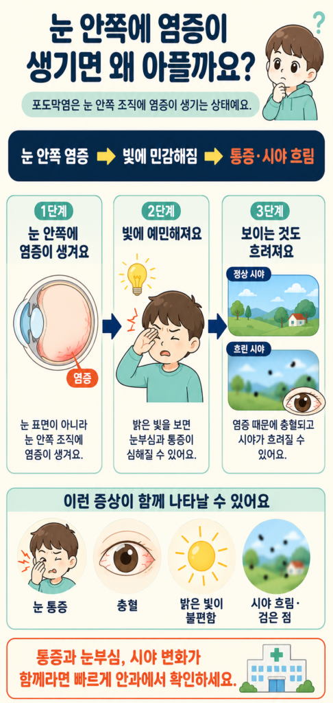 눈 안쪽 포도막에 염증이 생겨 충혈과 눈부심, 통증과 시야 흐림이 나타나는 과정을 설명한 일러스트