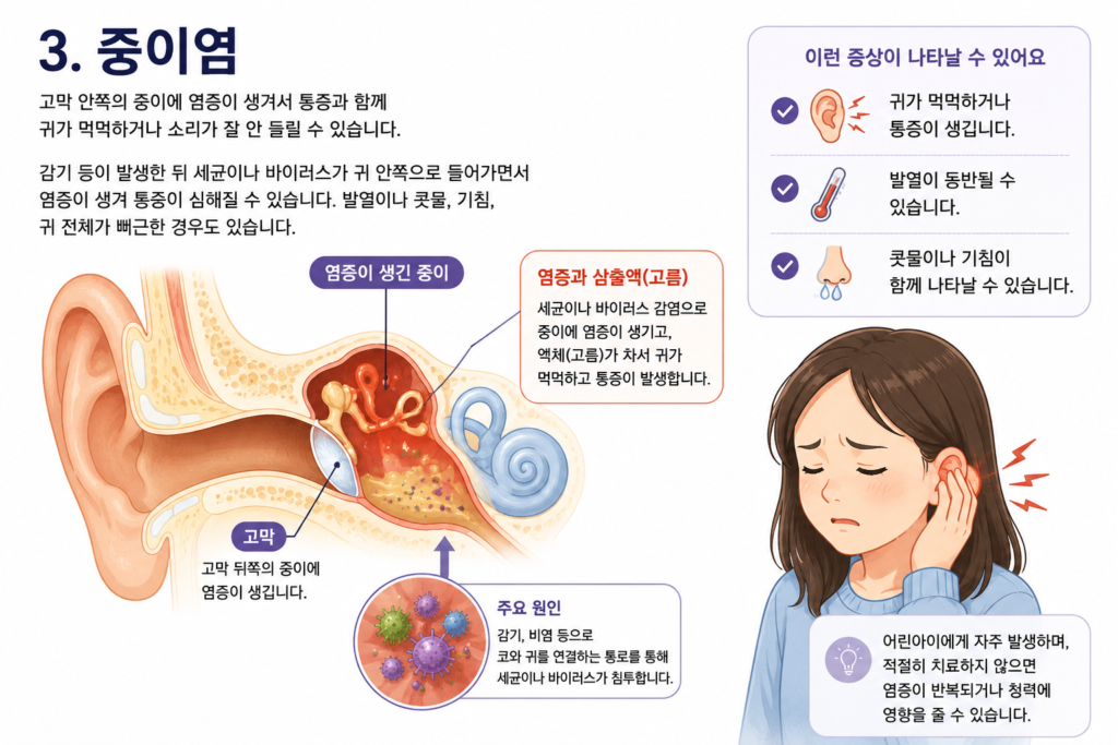 중이염으로 고막 안쪽에 염증과 액체가 생겨 귀가 먹먹하고 통증이 나타나는 원리를 설명하는 귀 단면 일러스트