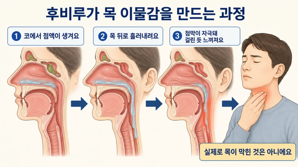 후비루가 코에서 목 뒤로 흘러 점막을 자극하고 실제로 막히지 않았지만 목 이물감을 만드는 과정