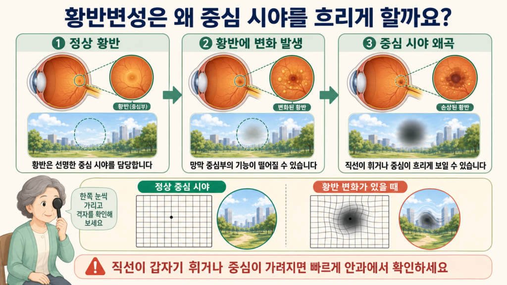 망막 중심부인 황반에 변화가 생겨 중심 시야가 흐려지고 직선이 휘거나 일부가 가려져 보이는 과정을 설명한 일러스트