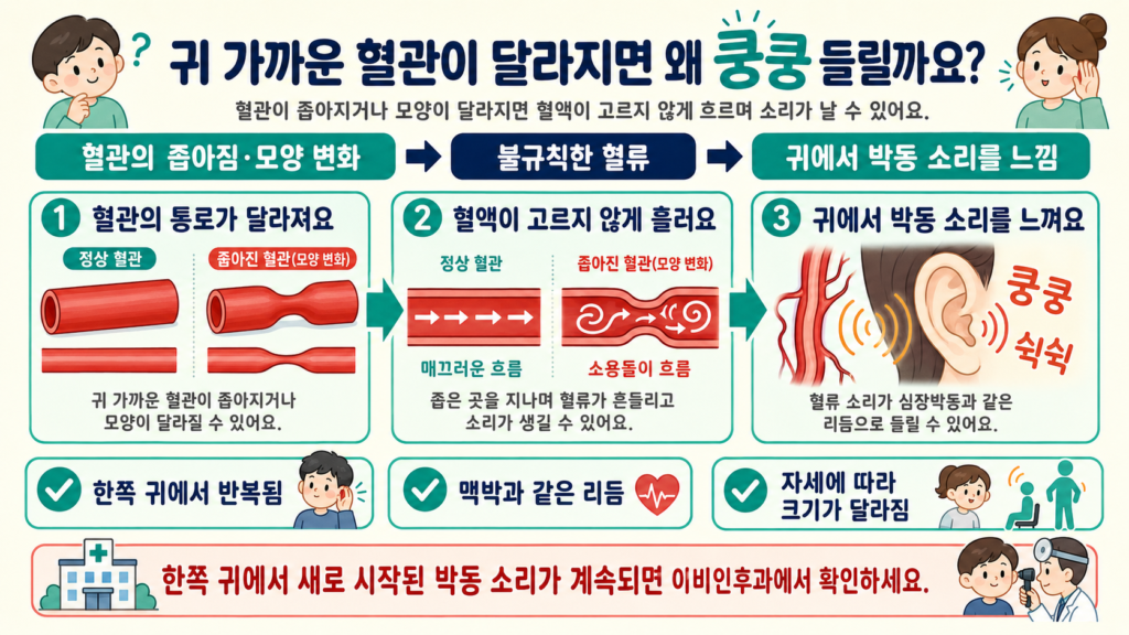 귀 가까이 있는 혈관의 좁아짐이나 비정상적인 연결로 혈액 흐름이 불규칙해지고 그 소리가 귀에 전달되는 과정을 쉽게 설명한 가로형 일러스트