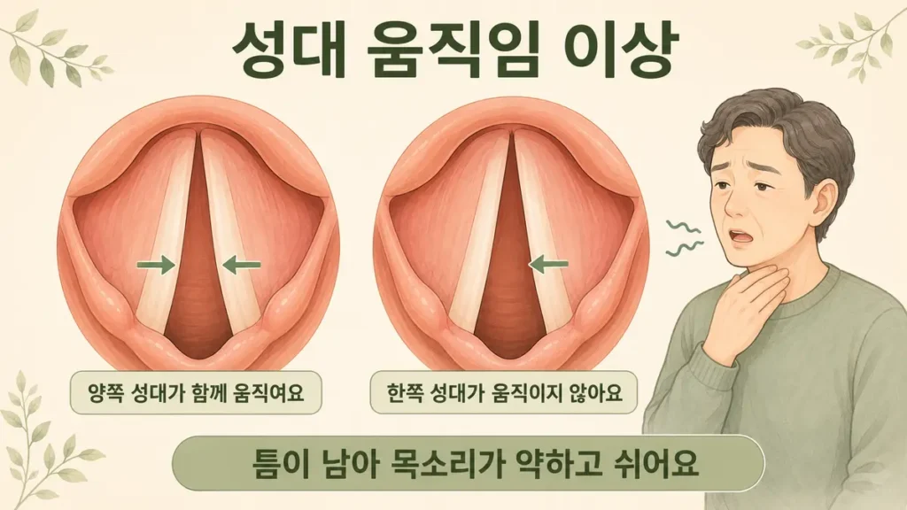 한쪽 성대가 움직이지 않아 틈이 남고 목소리가 약하고 쉬는 원리를 보여주는 이미지
