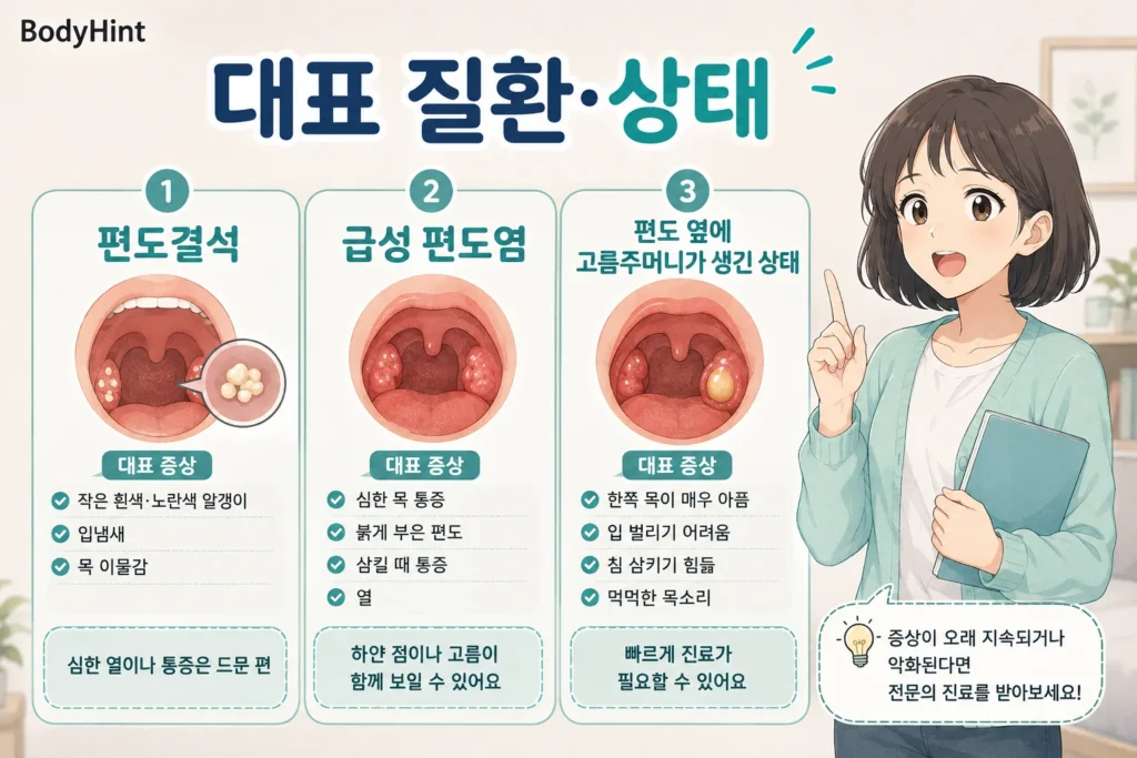 편도에 하얀 것이 보일 때 구분하는 편도결석, 급성 편도염, 편도 옆에 고름주머니가 생긴 상태의 대표 증상을 설명한 이미지