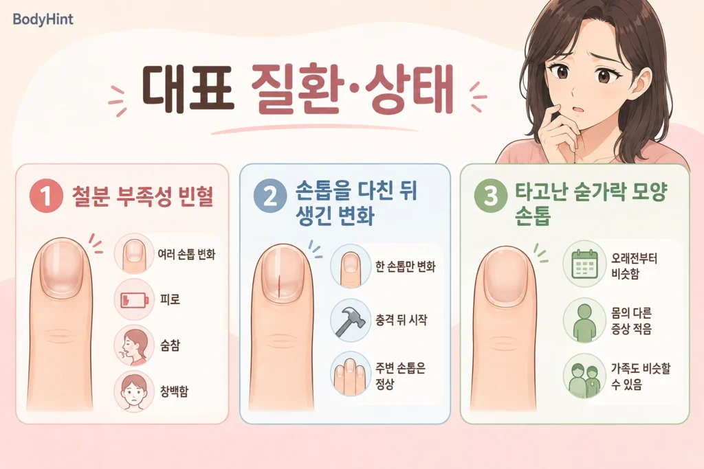 숟가락처럼 오목한 손톱에서 구분하는 철분 부족성 빈혈, 손톱 외상 후 변화, 타고난 숟가락 모양 손톱의 대표 증상을 설명한 이미지