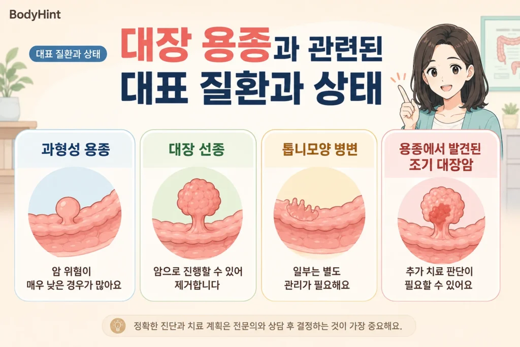대장 용종과 관련된 대표 상태로 과형성 용종, 대장 선종, 톱니모양 병변, 용종에서 발견된 조기 대장암을 비교한 BodyHint 인포그래픽