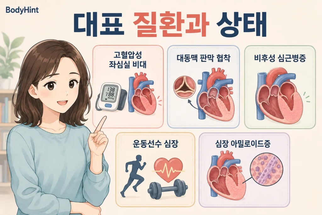 고혈압성 좌심실 비대, 대동맥 판막 협착, 비후성 심근병증, 운동선수 심장, 심장 아밀로이드증을 정리한 이미지