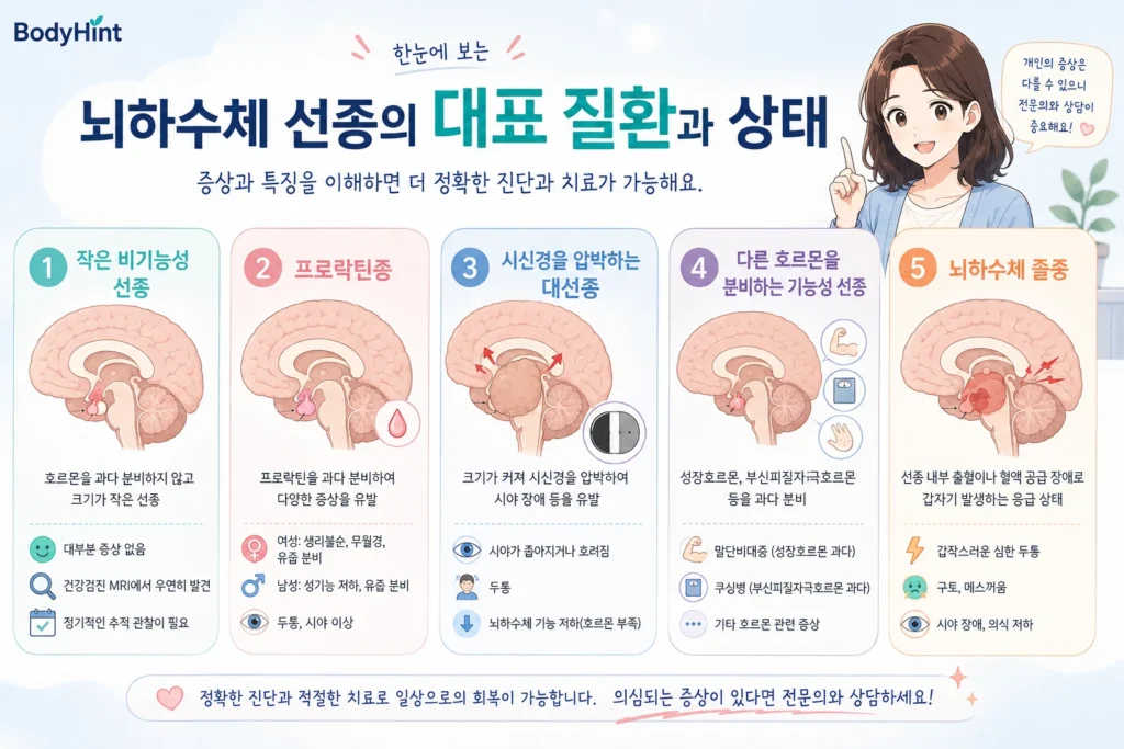 작은 비기능성 뇌하수체 선종, 프로락틴종, 시신경을 압박하는 대선종, 다른 호르몬을 분비하는 기능성 선종, 뇌하수체 졸중을 비교해 정리한 이미지